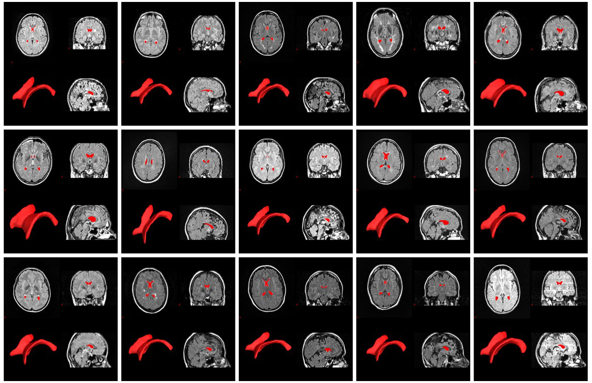 Tracking brain atrophy in MS could become routine, thanks to software developed at UB. Image